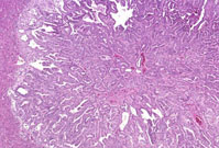 cholangiocarcinoma