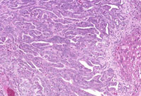 cholangiocarcinoma