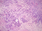 cholangiocarcinoma