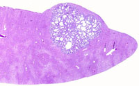 Cholangioma