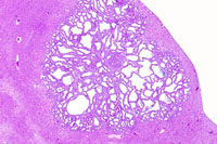 Cholangioma