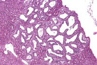 Cholangioma