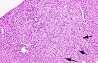 Hepatocellular adenoma