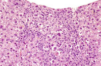 endothelial hyperplasia