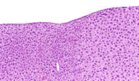 eosinophilic focus