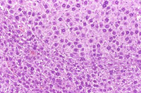 eosinophilic focus