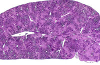 erythroleukemic