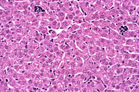 Extramedullary hematopoiesis