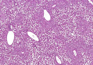 periportal fatty change in liver