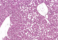 periportal fatty change in liver