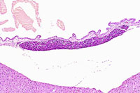 Ectopic pancreatic acinar tissue