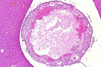 Acute Inflammation