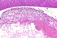 Acute Inflammation