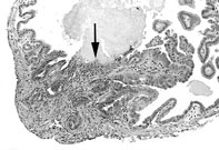 Papillary Hyperplasia