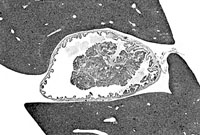 Papillary Adenoma