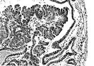 Papillary Adenoma