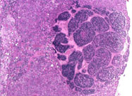 Hepatoblastoma