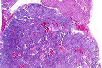 Hepatoblastoma