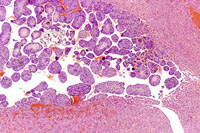 Hepatoblastoma