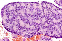 Hepatoblastoma