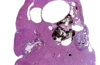 Hepatoblastoma