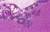 Hepatoblastoma