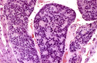 Hepatoblastoma