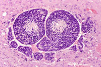 Hepatoblastoma