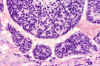 Hepatoblastoma