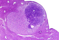 Basophilic hepatoblastoma