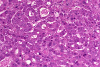 Hepatocellular Carcinoma