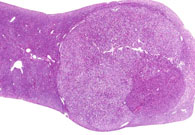 Hepatocellular Carcinoma