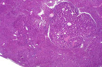 Hepatocellular Carcinoma