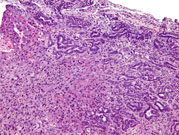 Hepatocholangiocarcinoma