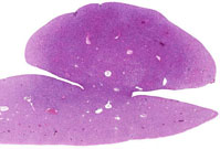 Hepatodiaphragmatic Nodule of Liver