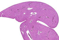 Hepatodiaphragmatic Nodule of Liver