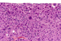 Bile duct cyst