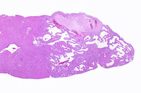 hemangiosarcoma