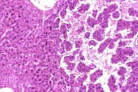 hemangiosarcoma