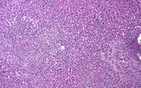 Histiocytic Sarcoma