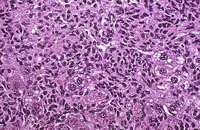 Histiocytic Sarcoma