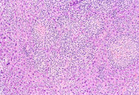 Histiocytic Sarcoma