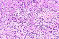 Histiocytic Sarcoma