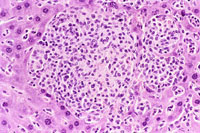 Histiocytic Sarcoma