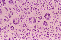 Histiocytic Sarcoma