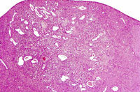 hemangiosarcoma
