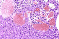 hemangiosarcoma