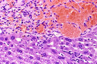 hemangiosarcoma