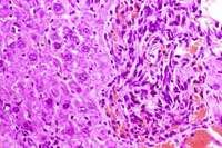 hemangiosarcoma