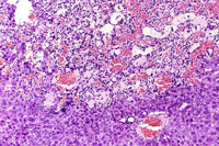 hemangiosarcoma
